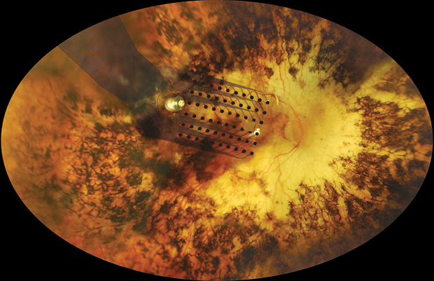 Figure 4: A microelectrode implanted in a retina. (Photo courtesy of Second Sight.)