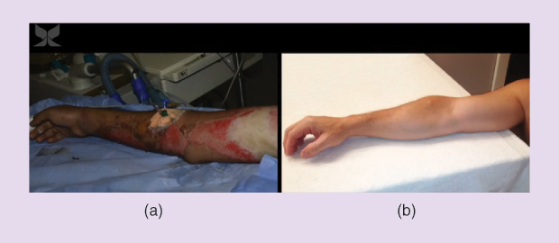 Figure 9: Remarkable (a) before and (b) after images of a severely burned state trooper’s arm show how RenovaCare’s SkinGun aided in his recovery. Note that RenovaCare Products are under development and not available for sale in the United States. (Photo courtesy of RenovaCare.)