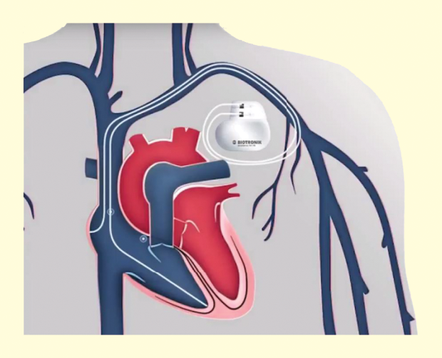 Figure 4: An example location of a dual-chamber pacemaker, showing atrial and ventricular lead pathways as well as the pulse generator.