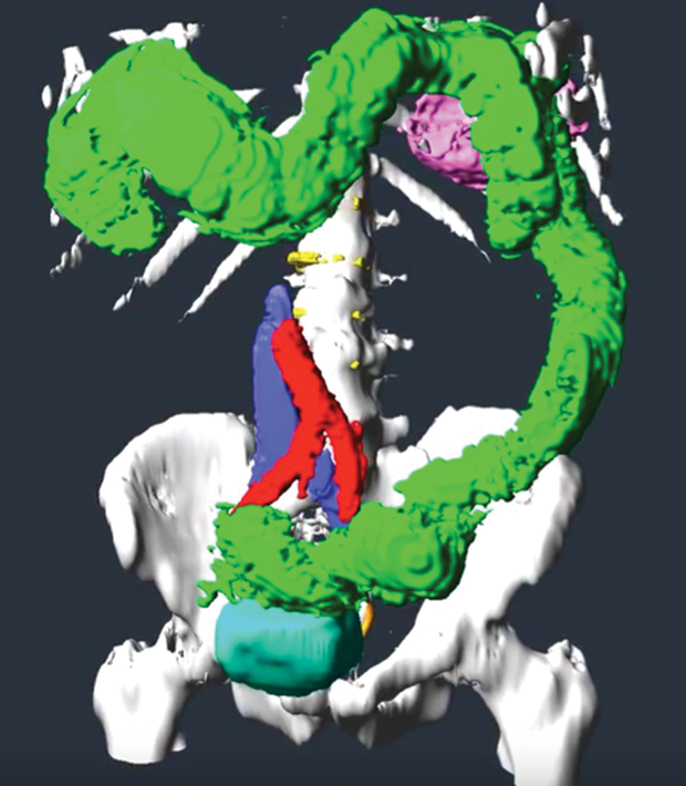 Figure 5: Jurgen Schulze’s colon visualization shows the kinks at both ends of Larry Smarr’s sigmoid colon, which sits on the bladder (blue-green), and that the upper colon is attached to the spleen (magenta). Also shown are major arteries and veins. (Image courtesy of Jurgen Schulze, Calit2.)