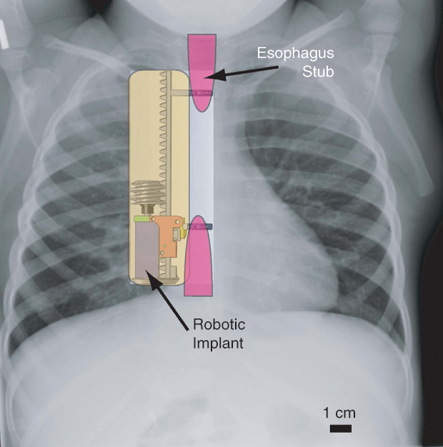 Figure 1: An illustration of a model robotic implant device designed to provide and monitor the traction needed to elongate a malformed, disconnected esophagus. The brainchild of Pierre Dupont of Harvard Medical School and Boston Children’s Hospital, the device, still in is early testing phase, is shown here as it might ultimately be used in a very young patient. (Image courtesy of Pierre Dupont.)