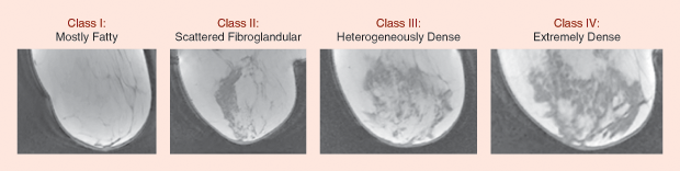 Figure 1: Representative T1-weighted sagittal breast MRIs illustrating the range of breast densities across patients.