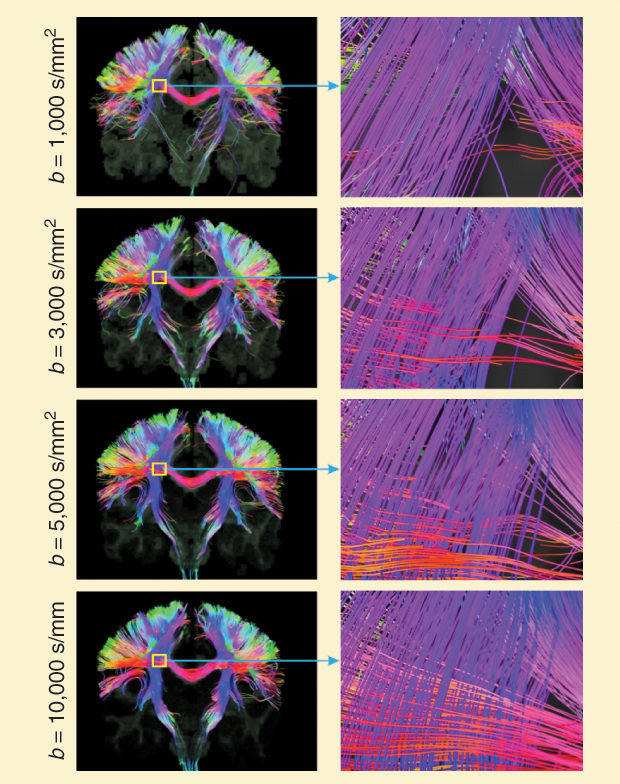 Figure 2: The front views of the fiber tracts reconstructed from dMRI data with different b-values. Streamlines passing by either of the bilateral postcentral gyri were selected and shown here. For different b-values, the same region in the centrum semiovale is boxed in yellow and magnified to reveal the differences. Reproduced from [4] with permission.