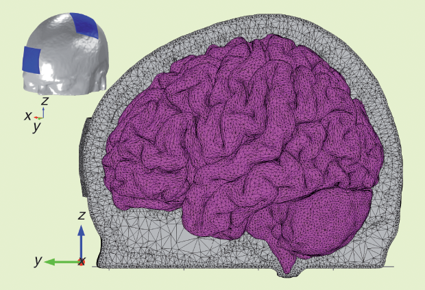 Figure 1: The sagittal view of the tetrahedra comprising the FE mesh of a realistic head model with two 5 x 7-cm^2 electrodes. The upper left inset shows the electrodes’ position. The mesh of the volume representing the GM is depicted in magenta.