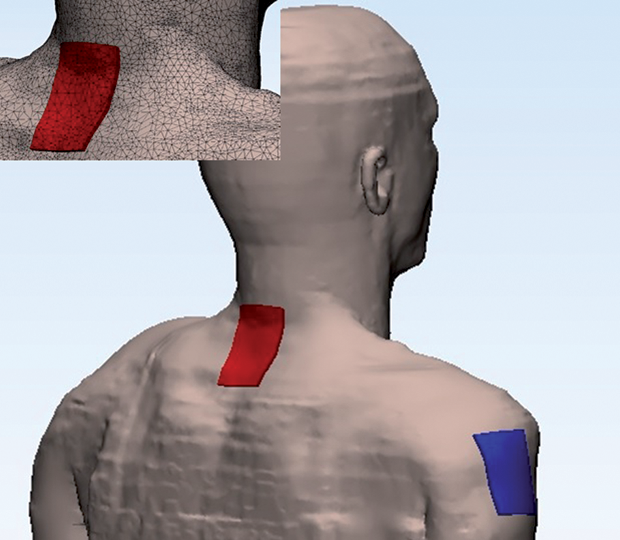 Figure 3: The electrode configuration for cervical tsDCS simulations. The upper left inset illustrates the mesh of the 5 × 7-cm^2 target electrode.