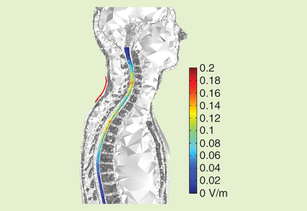 Figure 5: The volume plot of the average electric-field magnitude in the spinal cord superimposed to the volume mesh of the other tissues. The electrode over C7 is shown in red, and the electrode over the right deltoid is not visible in this plot.