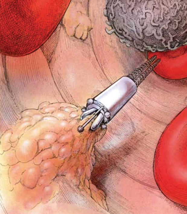 Figure 1: A nanorobot propelling itself through a blood vessel, as envisioned in Dewdney’s article in Scientific American. (Image courtesy of C. Donner.)