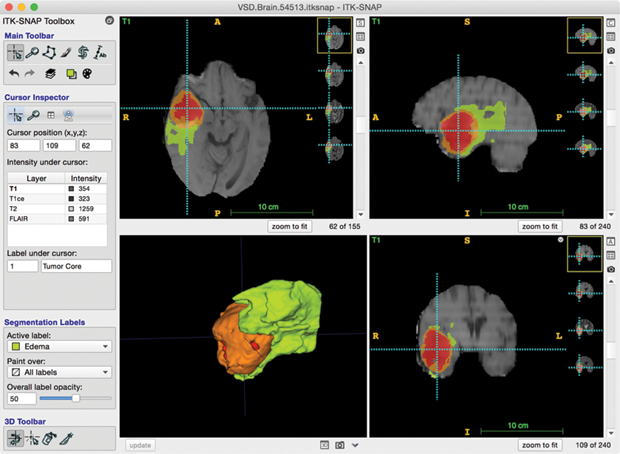 Figure 1: The main ITK-SNAP window in the course of brain tumor segmentation from a multimodality MRI data set. The user interface includes 2-D and 3-D visualization of the image data set and segmentation. The segmentation of the tumor and edema illustrated in this figure was generated using the semiautomatic segmentation mode in about 15 min. (Tumor image data are from the Medical Image Computing and Computer Assisted Intervention 2013 Multimodal Brain Tumor Segmentation (BRATS) challenge [11]. Tumor image data publicly available from the ITK-SNAP web page, http:// www.itksnap.org.)