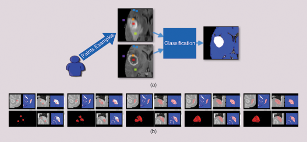 Figure 3: The ITK-SNAP semiautomatic segmentation pipeline. (a) Information from T2- and T1-weighted scans of the brain from a brain tumor study is reduced to a single foreground/background probability map (blue-white map) after the user marks examples of different tissue classes in the image. (b) A sequence of screenshots illustrating the deformable contour segmentation in the context of labeling the spleen in a CT scan.