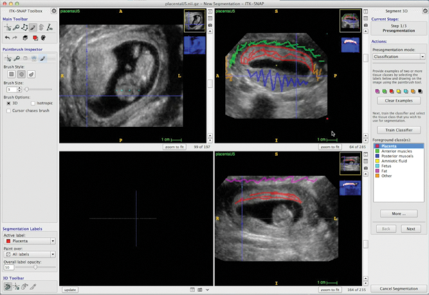 Figure 4: The semiautomatic segmentation pipeline in the ITK-SNAP can be applied in many problem domains. Here, it is used to label the placenta in a 3-D ultrasound scan. (Data set courtesy of Nadav Schwartz, M.D., Department of Obstetrics, University of Pennsylvania. Segmentation protocol developed by Artem Pashchinskiy.)