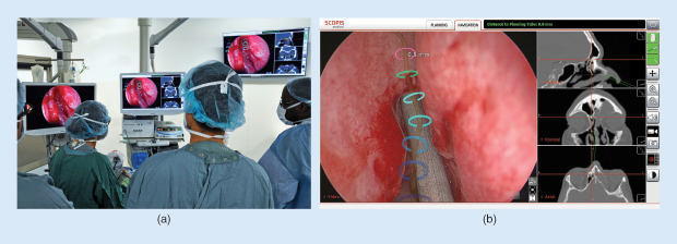 Figure 2: (a) Tewfik performs the first augmented-reality sinus operation in North America, in March 2017, as surgical staff and students look on, witnessing the same view he sees. (b) A close-up view of the monitor in (a), with colored semicircles highlighting the preplanned pathway. (Photos courtesy of McGill University Health Center, Montréal, Canada, and Scopis.)