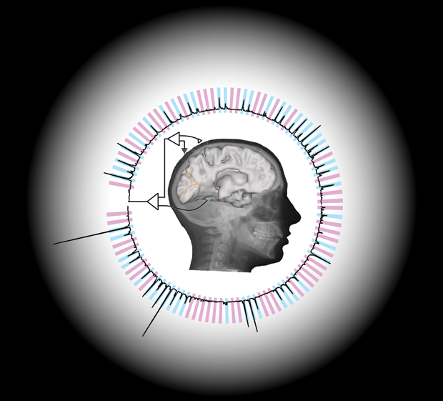 Figure 8: Using electrodes implanted in the temporal lobes of patients with epilepsy, researchers are using computational software to decode brain signals. This image shows the broadband response (black line) from an electrode (blue disk) as patients were shown images of faces (blue bars) and houses (pink bars) in 400-millisecond flashes. By combining these signals from around the brain, the researchers were able to accurately predict what patients saw with near-instantaneous precision. (Image courtesy of Kai Miller, Stanford University.)