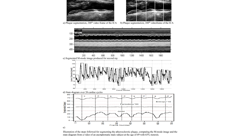 Texture Feature Variability in Ultrasound Video of the Atherosclerotic Carotid Plaque
