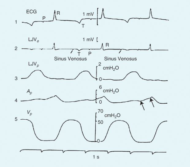 Figure 2: The electromechanical correlation of cardiac events with records obtained from an anesthetized snake, Constrictor constrictor (Brazilian boa constrictor). The upper channel is the surface ECG, while the second and third levels (LJVe and LJVp ) were recorded with a catheter introduced via the left jugular vein (LJV) carrying electrodes and tubing connected to a sensitive pressure transducer. The subscripts e and p stand for electrical and pressure, respectively. The sinus venosus signal amplitude is very small, and it could be improved by shifting the catheter, but at the expense of losing pressure amplitude; thus, a compromise had to be reached. The sinus venosus pacemaker was followed by the sinus contraction (channel 3), reaching a maximum pressure of approximately 1.5 cm H20. The atrial activity P is seen in the first two channels, just preceding the atrial contraction, which is shown in channel 4 (a small atrial pressure Ap recorded with a tube inserted through the atrial wall). The lower channel 5 stands for the intraventricular pressure Vp obtained with a catheter and another sensor. The first arrow on the right in channel 4 indicates the beginning of atrial contraction, while the second arrow probably shows the closure of the atrioventricular valve. The atrial pressure peak reflects the isometric ventricular contraction through the bulging back of the atrioventricular valve. The small longer wave before atrial contraction is an indication of the sinus venosus contraction [14], [15]. (Image courtesy of the author.)