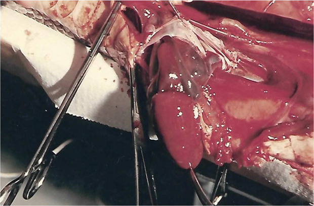 Figure 3: The LJV and minor sinus venosus (MSV) are shown, while the whole heart keeps beating. The LJV appears within the atrial sulcus and the MSV. The left side of the left atrium is also seen. The photo is available in [13], where a full account of the procedure and results are described. (Photo courtesy of the author.)