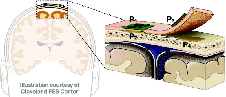 Conceptual illustration of the placement of capacitive elements with tissue as the dielectric material for C–WPT to cortical implants.