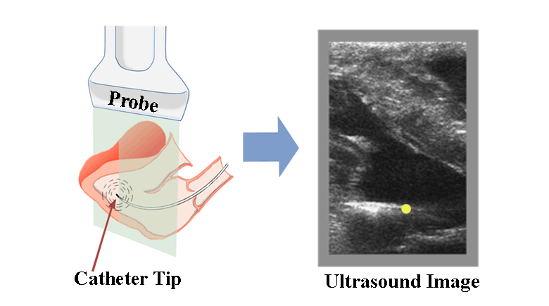 Unambiguous Identification and Visualization of an Acoustically Active Catheter by Ultrasound Imaging in Real Time: Theory, Algorithm, and Phantom Experiments
