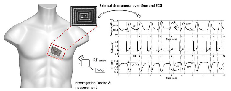 Passive Self Resonant Skin Patch Sensor to Monitor Intraventricular Volu...
