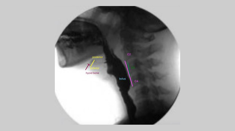 Position of the hyoid bone, C2−C4 and C3 on a videofluoroscopic image