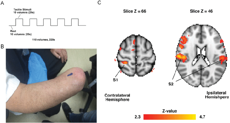 Correlates of Residual Limb Pain: From Residual Limb Length and Usage to Metabolites and Activity in Secondary Somatosensory Cortex