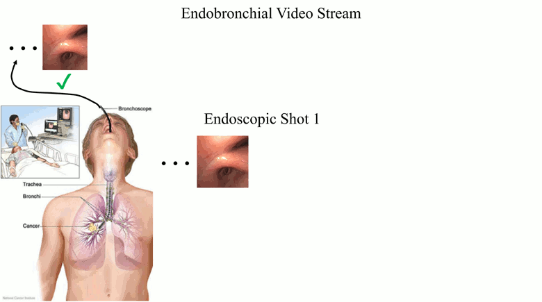 Efficient Bronchoscopic Video Summarization
