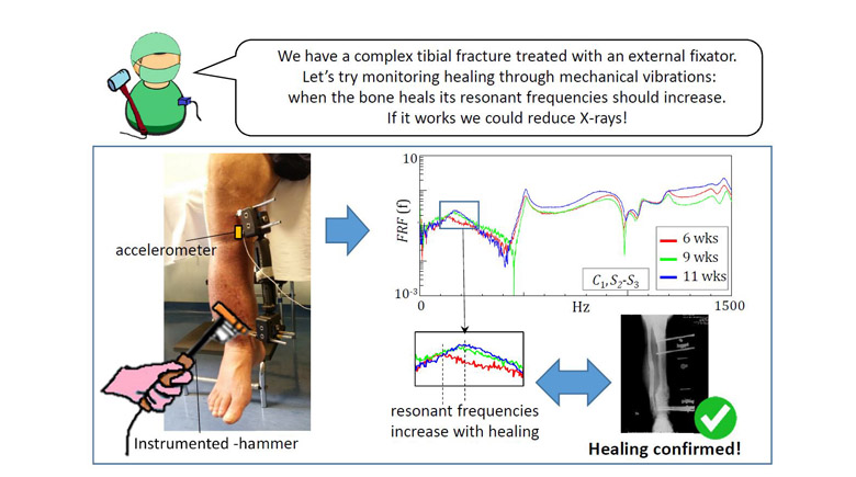 Fracture healing monitoring by impact tests