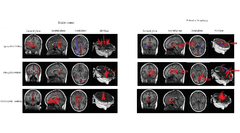 A Magnetoencephalography Study of Pediatric Interictal Neuromagnetic Activity Changes and Brain Network Alterations Caused by Epilepsy in the High Frequency (80–1000 Hz)