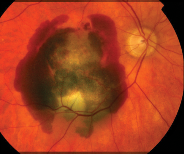 Figure 1. In wet AMD, shown in this retinal scan, abnormal blood vessels develop beneath the retina and macula, and leak blood and serum that raise and compromise the macula, which is the central portion of the retina. (Photo courtesy of Moorfields Eye Hospital.)