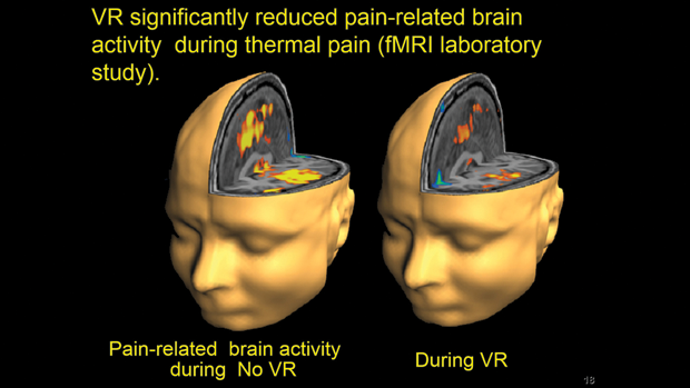 Figure 5. Patients report large reductions in pain during VR, and fMRI brain scans while patients play SnowWorld similarly show large reductions in pain-related brain activity. (Photograph by Todd Richards and Aric Bills, University of Washington. Copyright Hunter Hoffman/ University of Washington/www.vrpain.com.)