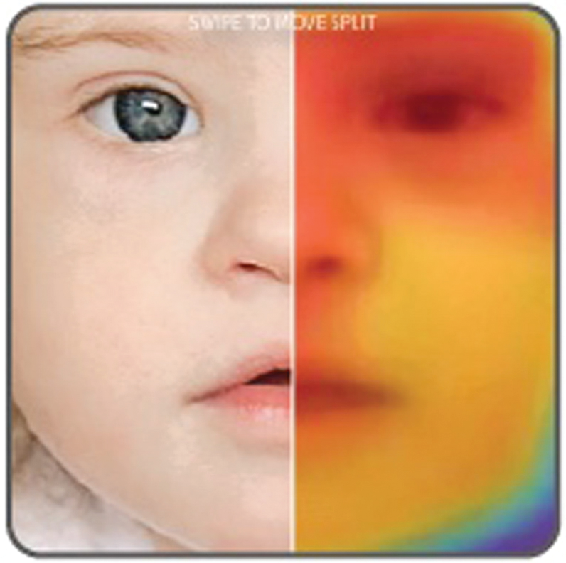 Figure 2. Heat map aspect of Face2Gene, highlighting which areas from a patient’s facial photo most closely align with the gestalt of a certain syndrome.