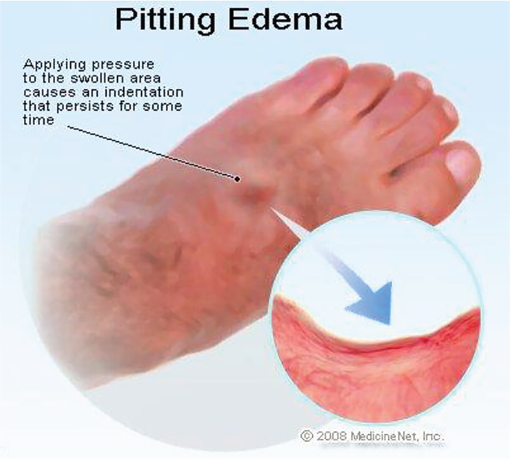 Figure 2. Pitting edema. (Image courtesy of MedicineNet.)